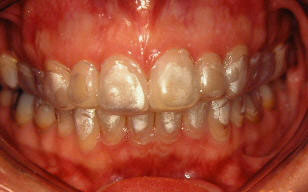 Invisalign/Clear Correct