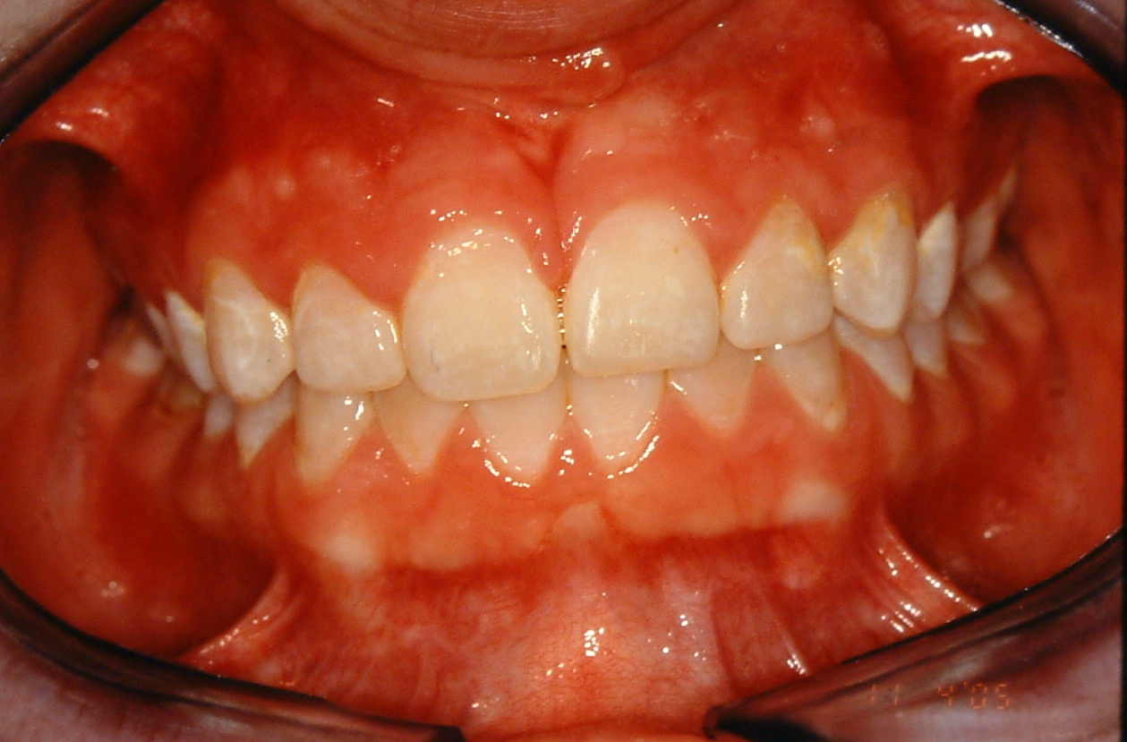 Limited Orthodontic Treatment Gallery