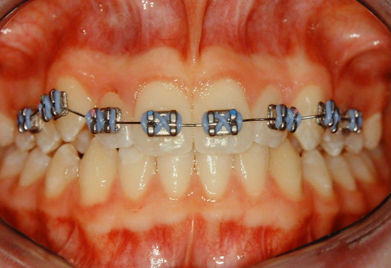 Traditional Braces